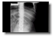 Chest x-ray