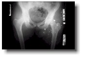 Pelvic x-ray