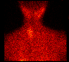 parathyroid.gif (262709 bytes)