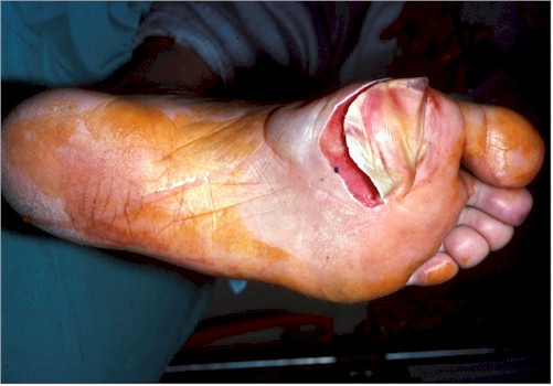 Blister
