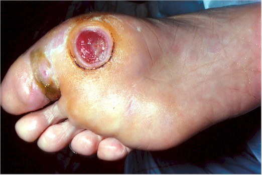 Ulcer resulting from callous in previous  picture