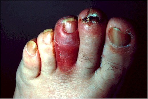 Infected toe