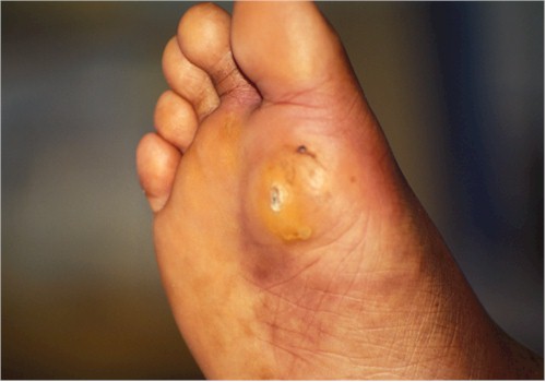 Callous caused by plantar pressures  