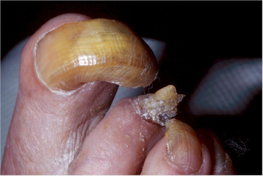 Onychogryphosis