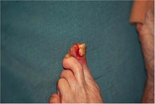 Ingrown nail