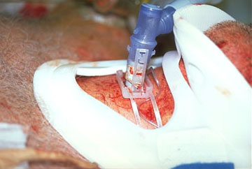 Surgical Airway : Cricothyroidotomy